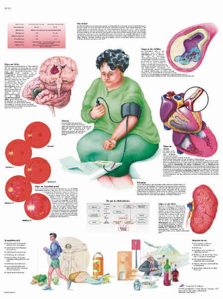 Planche anatomique - Hypertension