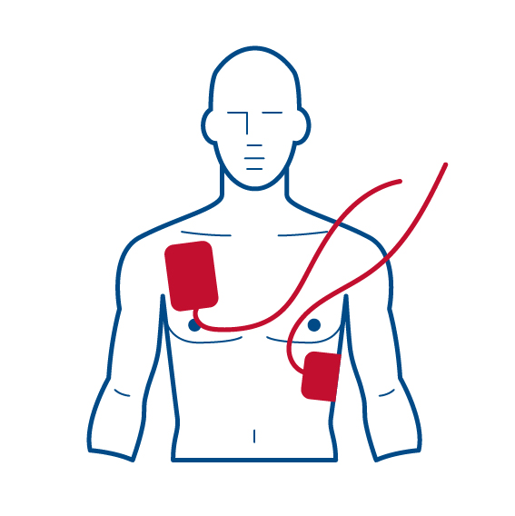 Placement of AED pads